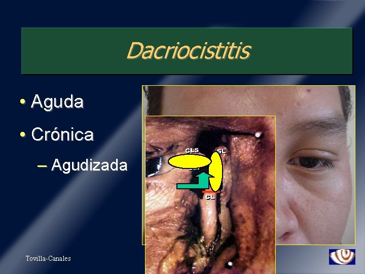 Dacriocistitis • Aguda • Crónica – Agudizada Tovilla-Canales 