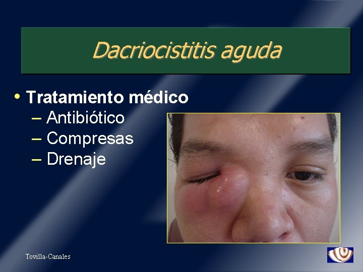 Dacriocistitis aguda • Tratamiento médico – Antibiótico – Compresas – Drenaje Tovilla-Canales 
