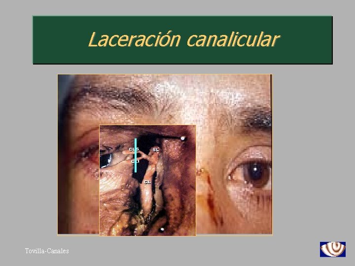Laceración canalicular Tovilla-Canales 
