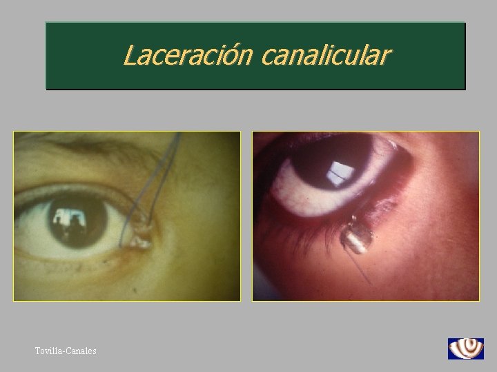 Laceración canalicular Tovilla-Canales 