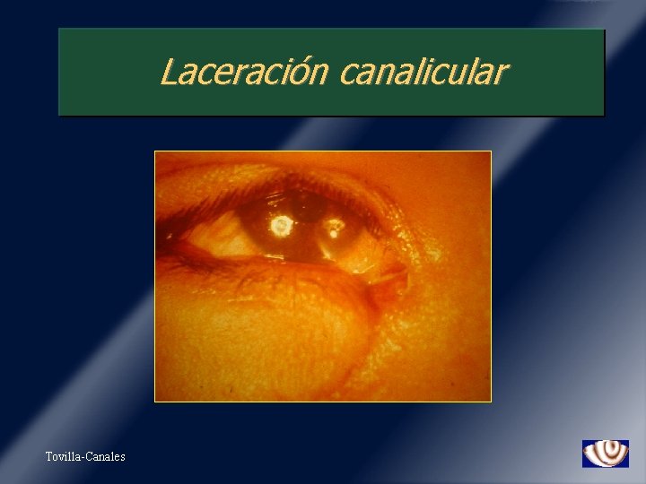 Laceración canalicular Tovilla-Canales 