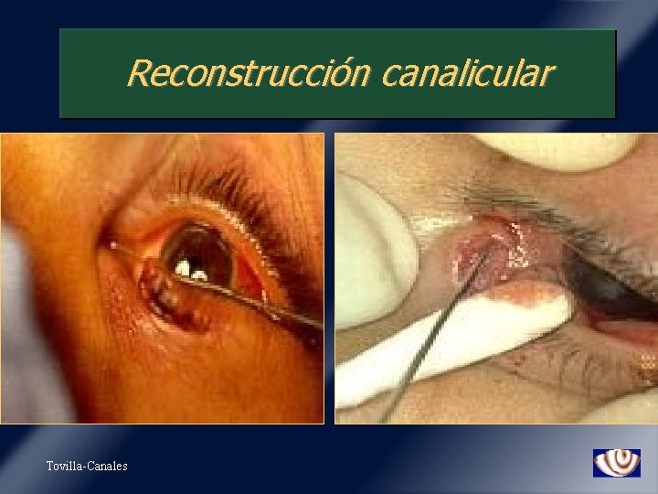 Reconstrucción canalicular v Tovilla-Canales 