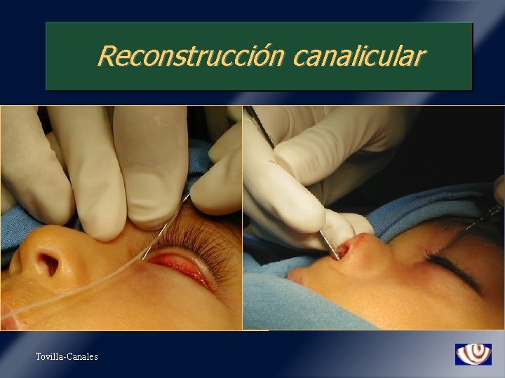 Reconstrucción canalicular Tovilla-Canales 