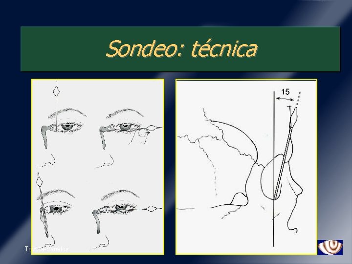 Sondeo: técnica Tovilla-Canales 