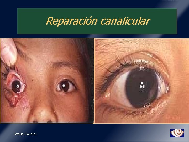 Reparación canalicular v Tovilla-Canales 