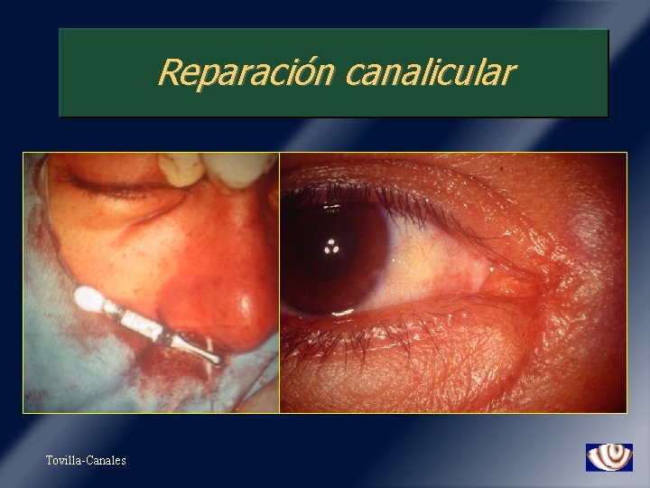 Reparación canalicular Tovilla-Canales 