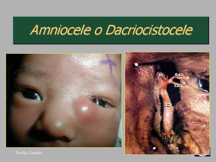 Amniocele o Dacriocistocele Tovilla-Canales 