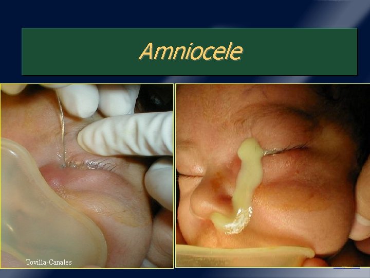 Amniocele Tovilla-Canales 