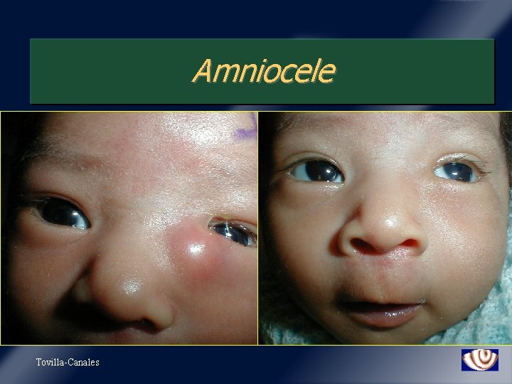 Amniocele Tovilla-Canales 
