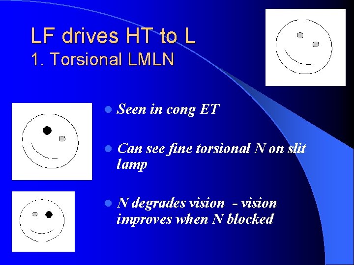 LF drives HT to L 1. Torsional LMLN l Seen in cong ET l