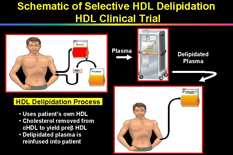 Schematic of Selective HDL Delipidation HDL Clinical Trial Plasma HDL Delipidation Process • Uses