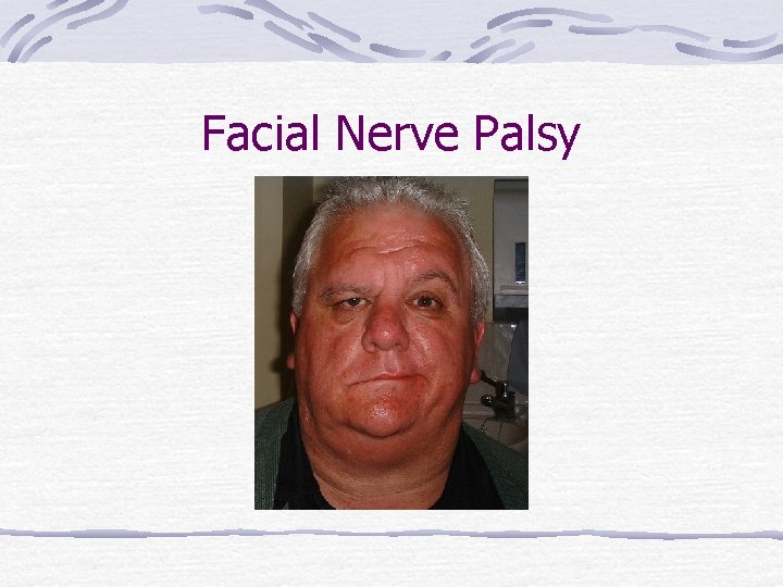 Facial Nerve Palsy 