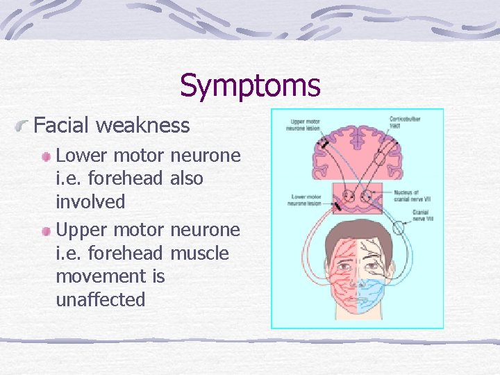 Symptoms Facial weakness Lower motor neurone i. e. forehead also involved Upper motor neurone