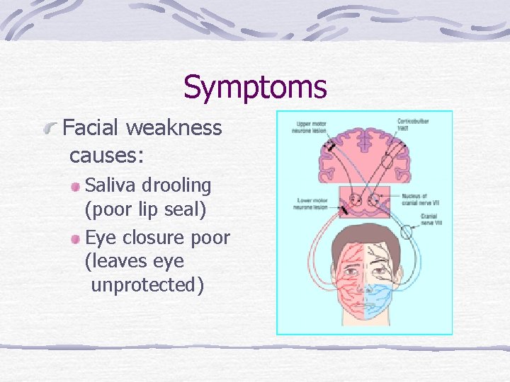 Symptoms Facial weakness causes: Saliva drooling (poor lip seal) Eye closure poor (leaves eye