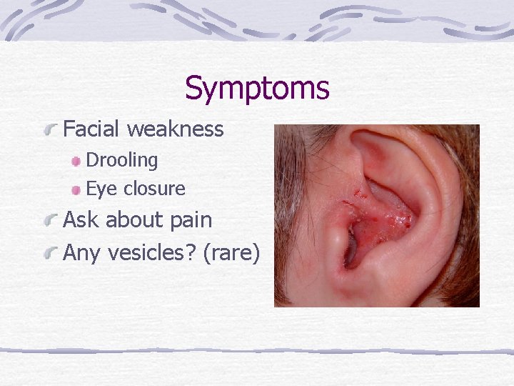 Symptoms Facial weakness Drooling Eye closure Ask about pain Any vesicles? (rare) 