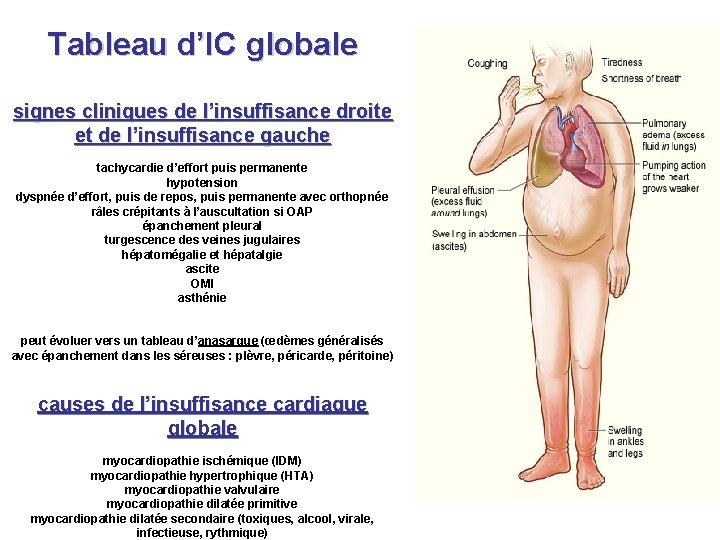 Tableau d’IC globale signes cliniques de l’insuffisance droite et de l’insuffisance gauche tachycardie d’effort Tableau d’IC globale signes cliniques de l’insuffisance droite et de l’insuffisance gauche tachycardie d’effort