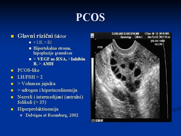 PCOS n Glavni rizični faktor n > LH, > E 2 n Hipertekalna stroma,