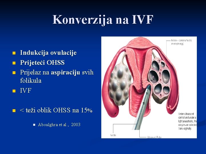 Konverzija na IVF n Indukcija ovulacije Prijeteći OHSS Prijelaz na aspiraciju svih folikula IVF