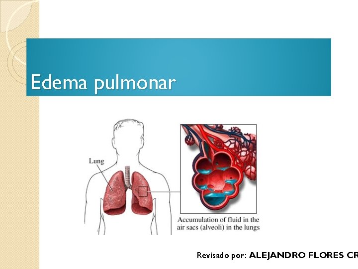 Edema pulmonar Revisado por: ALEJANDRO FLORES CR 