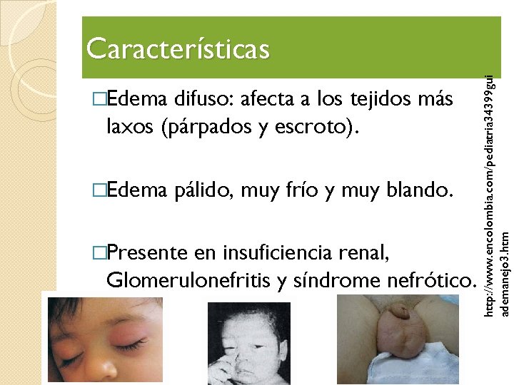 �Edema difuso: afecta a los tejidos más laxos (párpados y escroto). �Edema pálido, muy