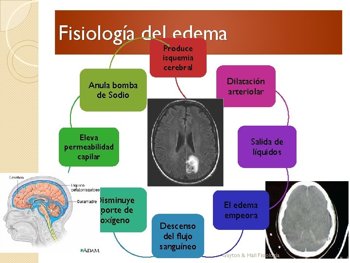 Fisiología del edema Produce isquemia cerebral Dilatación arteriolar Anula bomba de Sodio Eleva permeabilidad