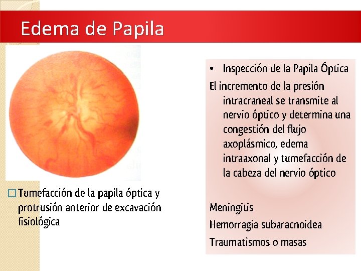 Edema de Papila • Inspección de la Papila Óptica El incremento de la presión