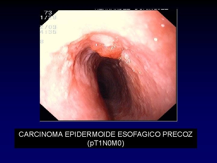 CARCINOMA EPIDERMOIDE ESOFAGICO PRECOZ (p. T 1 N 0 M 0) CARCINOMA EPIDERMOIDE ESOFAGICO PRECOZ (p. T 1 N 0 M 0)
