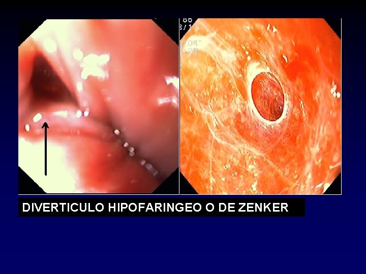 DIVERTICULO HIPOFARINGEO O DE ZENKER DIVERTICULO HIPOFARINGEO O DE ZENKER