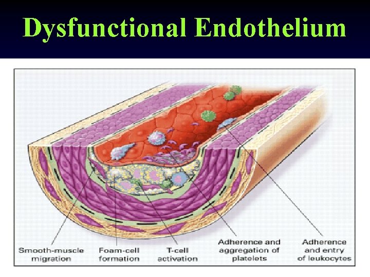 Dysfunctional Endothelium 