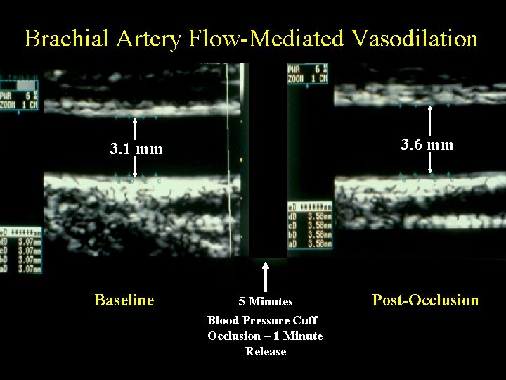 Brachial Artery Flow-Mediated Vasodilation 3. 6 mm 3. 1 mm Baseline 5 Minutes Blood