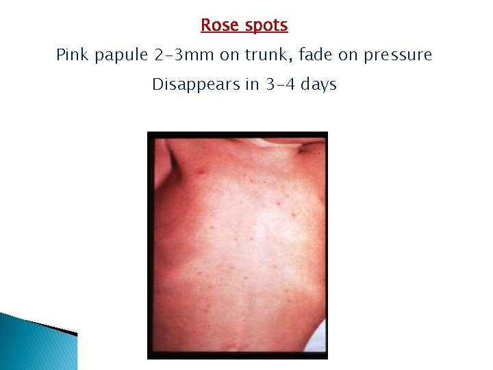 Rose spots Pink papule 2 -3 mm on trunk, fade on pressure Disappears in Rose spots Pink papule 2 -3 mm on trunk, fade on pressure Disappears in