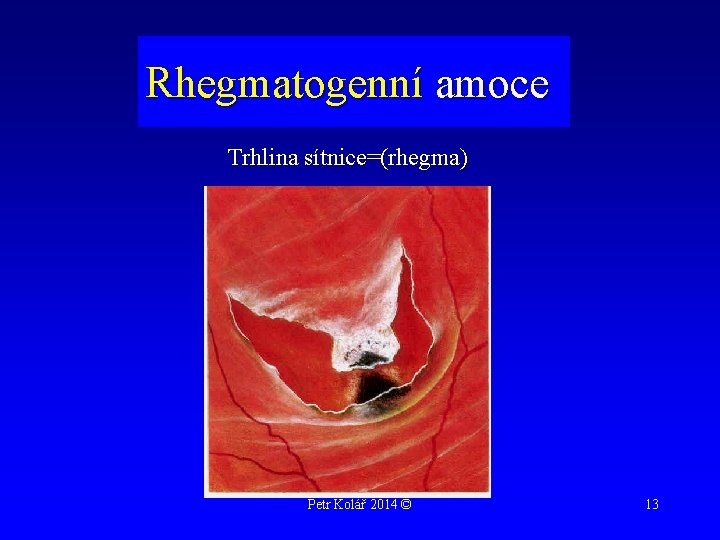 Rhegmatogenní amoce Trhlina sítnice=(rhegma) Petr Kolář 2014 © 13 