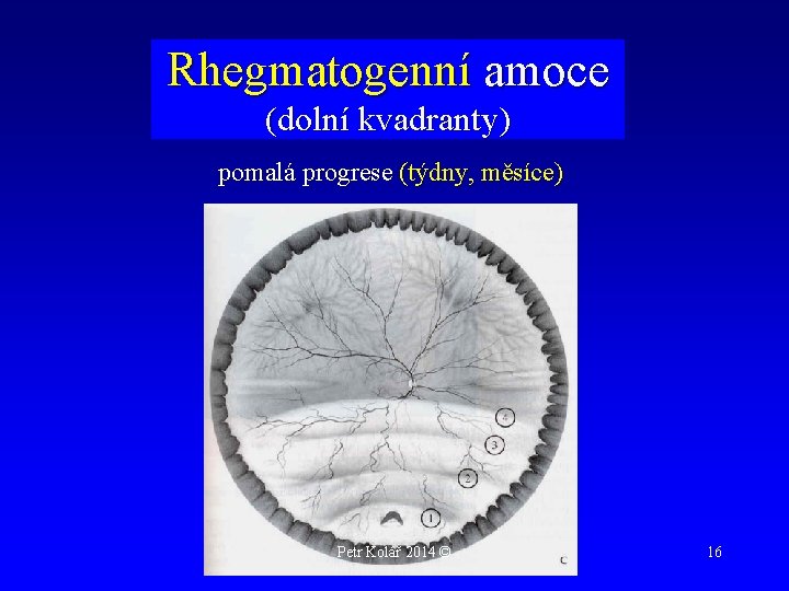 Rhegmatogenní amoce (dolní kvadranty) pomalá progrese (týdny, měsíce) Petr Kolář 2014 © 16 