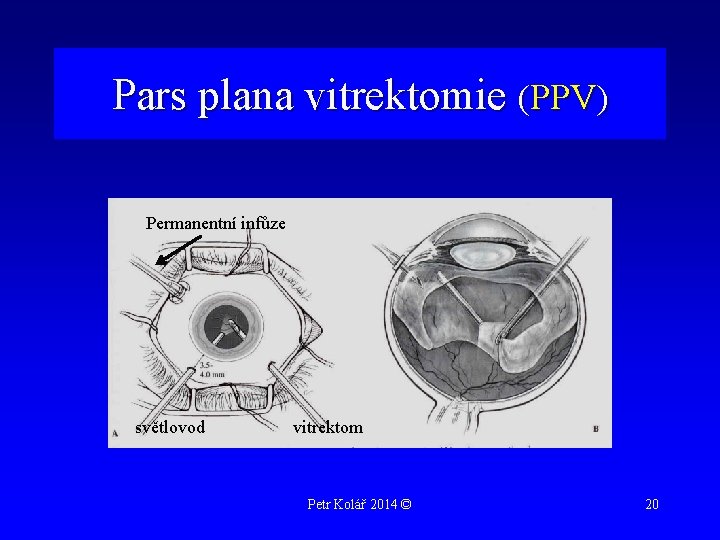 Pars plana vitrektomie (PPV) Permanentní infůze světlovod vitrektom Petr Kolář 2014 © 20 