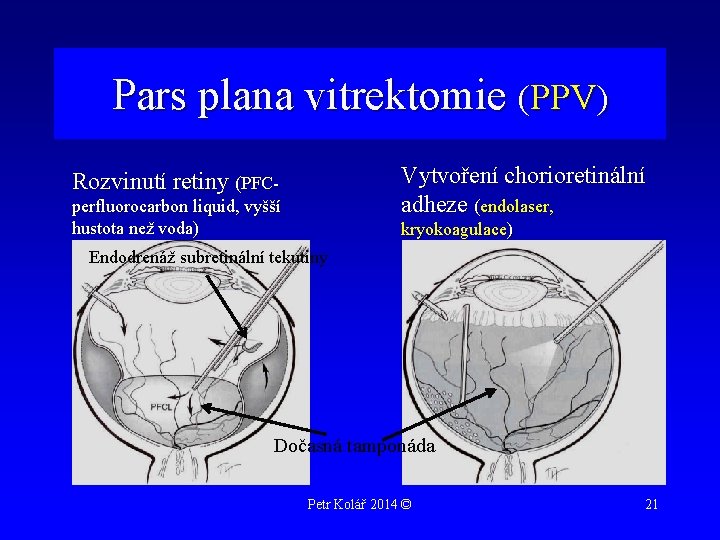 Pars plana vitrektomie (PPV) Vytvoření chorioretinální adheze (endolaser, Rozvinutí retiny (PFCperfluorocarbon liquid, vyšší hustota