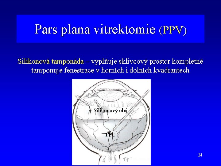 Pars plana vitrektomie (PPV) Silikonová tamponáda – vyplňuje sklivcový prostor kompletně tamponuje fenestrace v