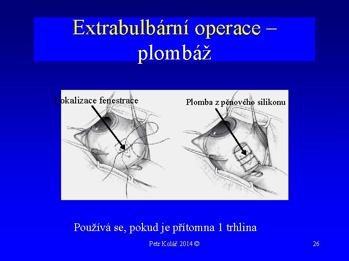 Extrabulbární operace – plombáž Lokalizace fenestrace Plomba z pěnového silikonu Používá se, pokud je