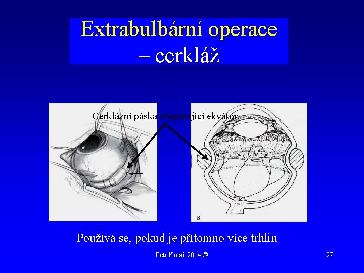 Extrabulbární operace – cerkláž Cerklážní páska obepínající ekvátor Používá se, pokud je přítomno více