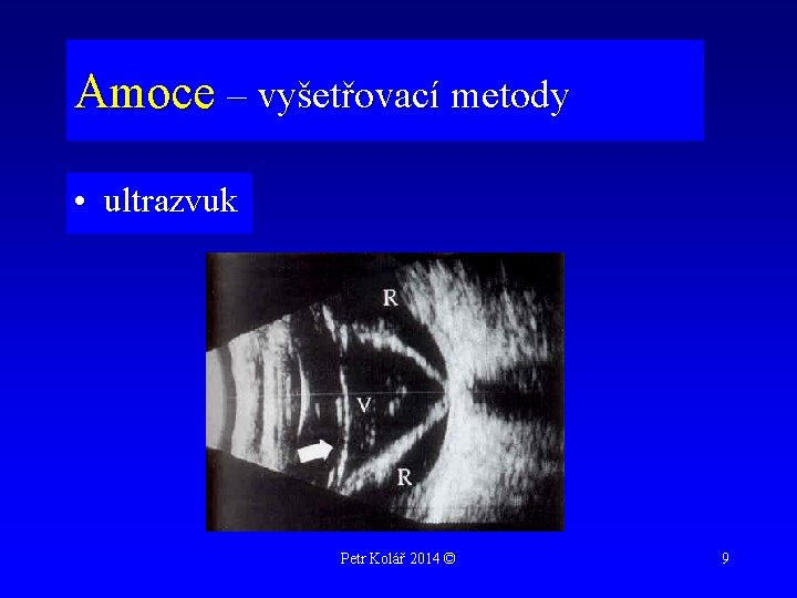 Amoce – vyšetřovací metody • ultrazvuk Petr Kolář 2014 © 9 