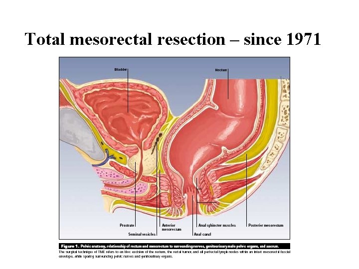Total mesorectal resection – since 1971 
