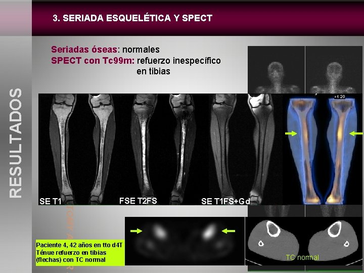 3. SERIADA ESQUELÉTICA Y SPECT S a SE T 1 NORMAL ANATOMY AND MR