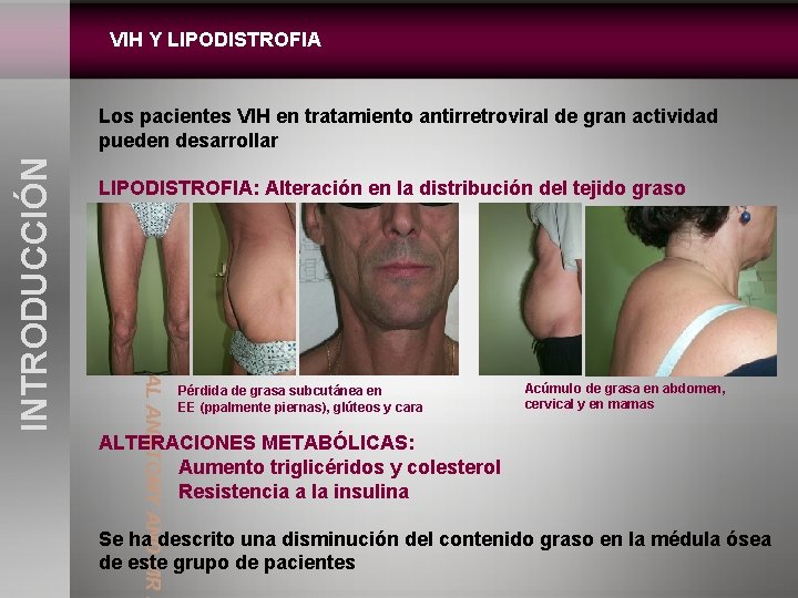 VIH Y LIPODISTROFIA: Alteración en la distribución del tejido graso S a NORMAL ANATOMY