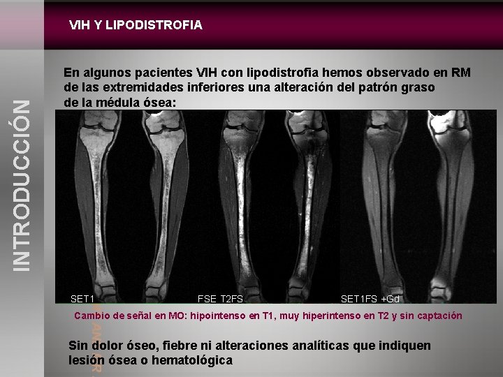 En algunos pacientes VIH con lipodistrofia hemos observado en RM de las extremidades inferiores
