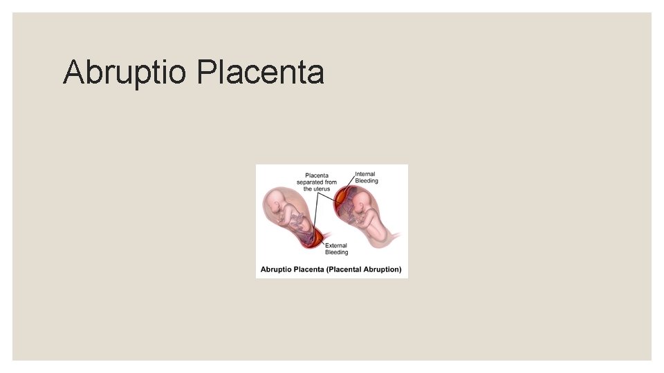 Abruptio Placenta 