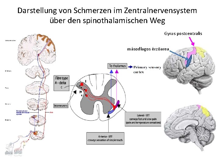 Darstellung von Schmerzen im Zentralnervensystem über den spinothalamischen Weg Gyrus postcentralis másodlagos érzőarea 