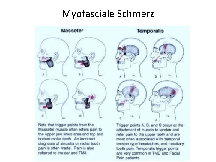 Myofasciale Schmerz 