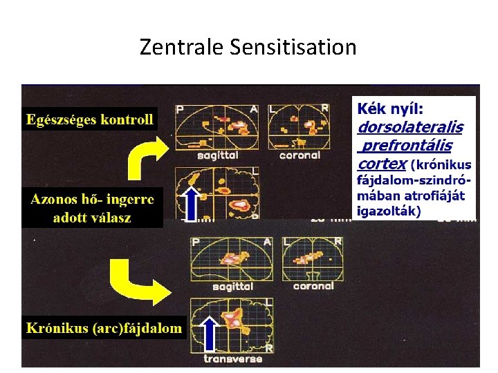 Zentrale Sensitisation 