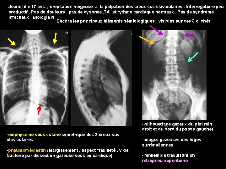 Jeune fille 17 ans ; crépitation neigeuse à la palpation des creux sus claviculaires.