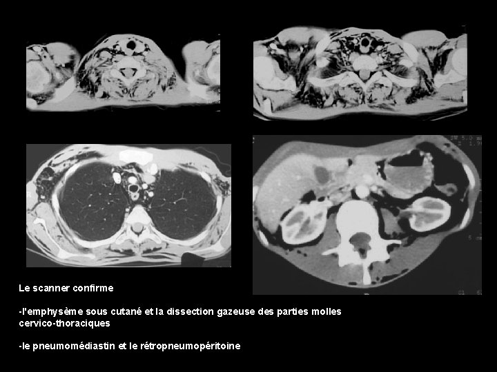 Le scanner confirme -l'emphysème sous cutané et la dissection gazeuse des parties molles cervico-thoraciques