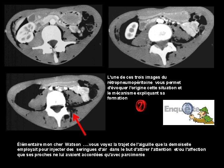 L'une de ces trois images du rétropneumopéritoine vous permet d'évoquer l'origine cette situation et